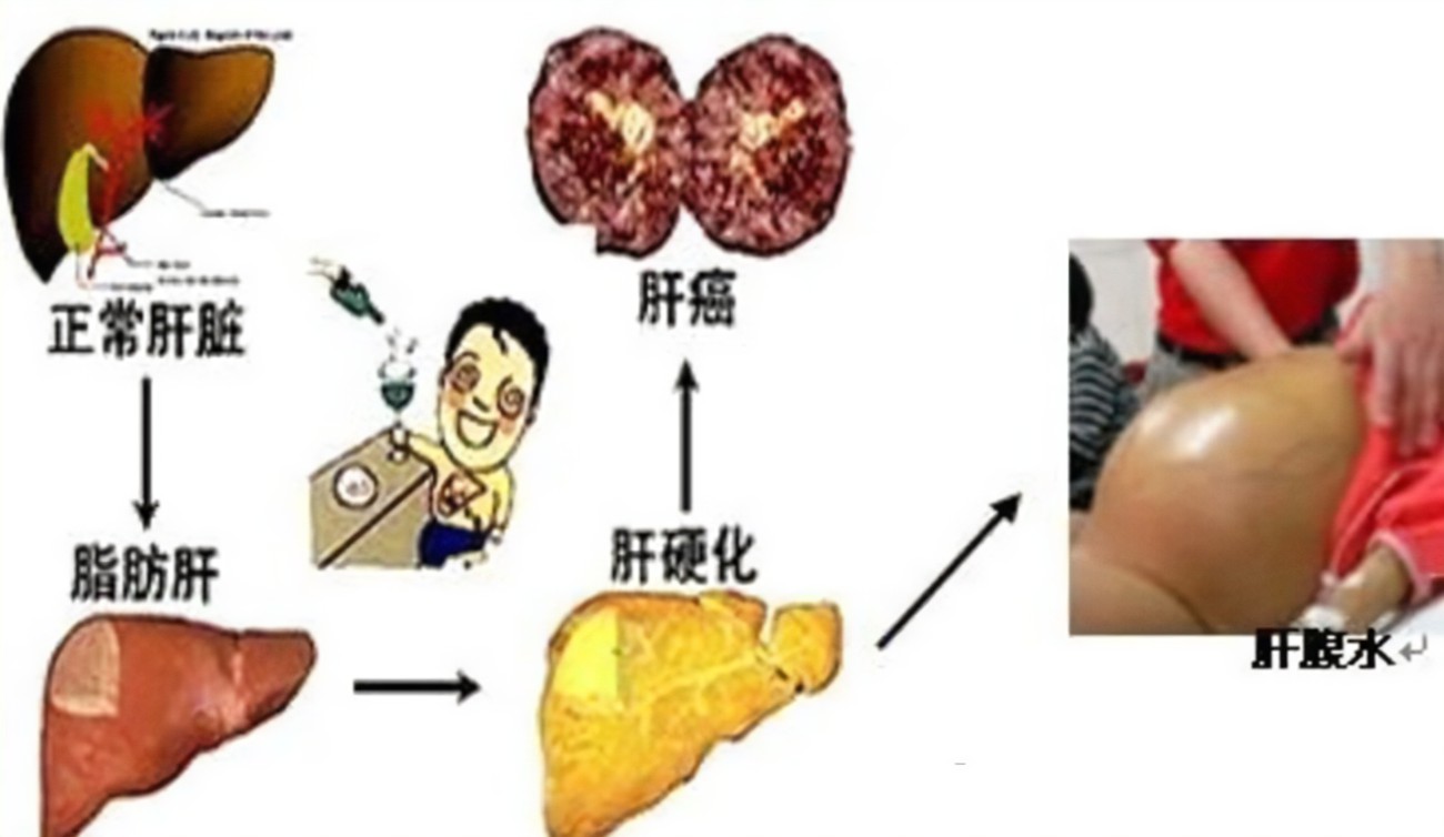 查出肝硬化還有救嗎？